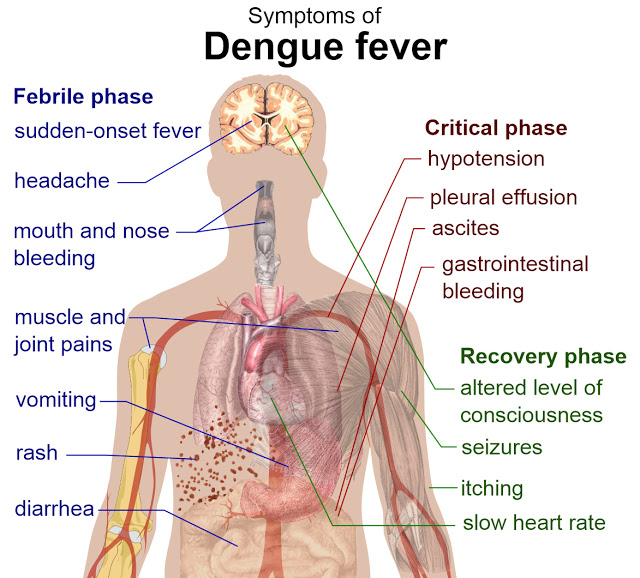 moustique tigre symptomes de la dengue