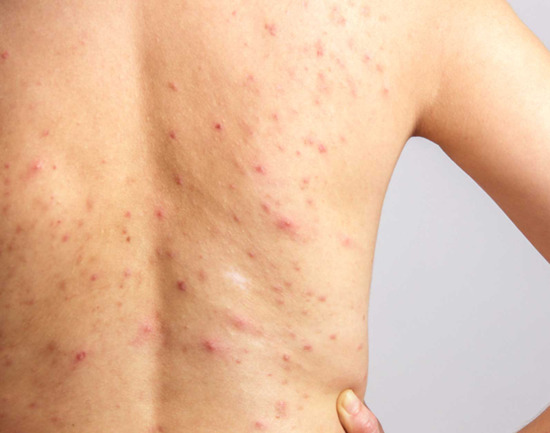 Comment enlever un bouton d'acné dans le dos ?