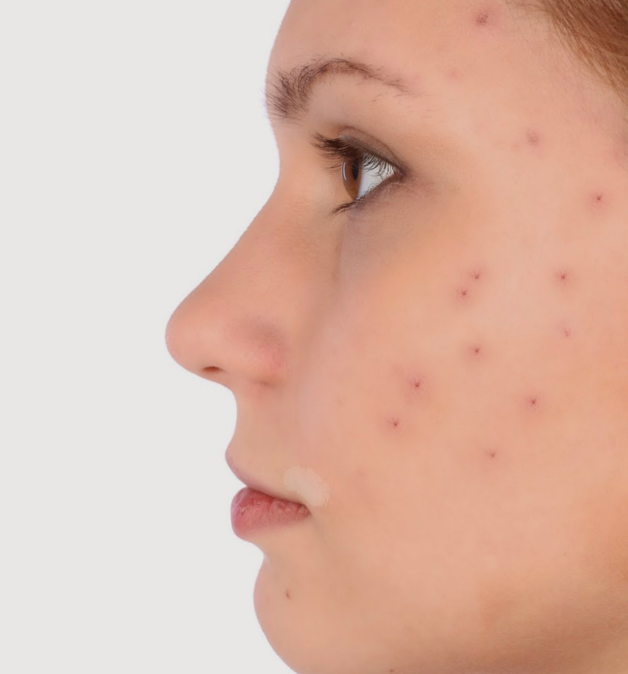 Comment combattre l'acné sur le visage ?
